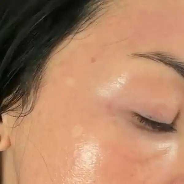 The same client’s cheek after Cosmelan treatment at Glow By Yaz, photographed at a different time and in different lighting