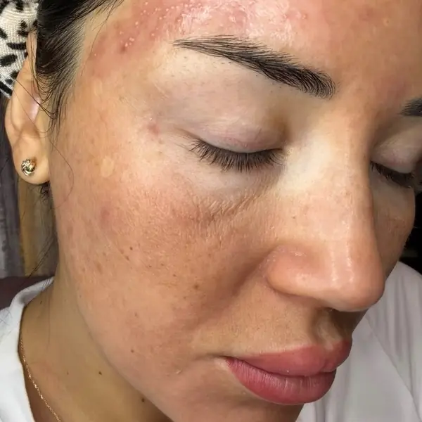 Close-up of a client’s cheek before Cosmelan treatment at Glow By Yaz