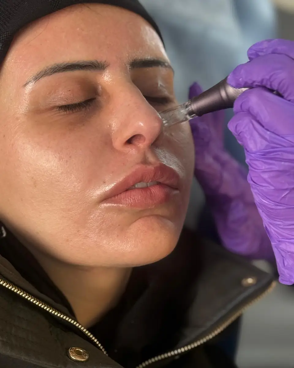 A practitioner in purple gloves using a microneedling pen beside a client’s nose during a treatment at Glow By Yaz